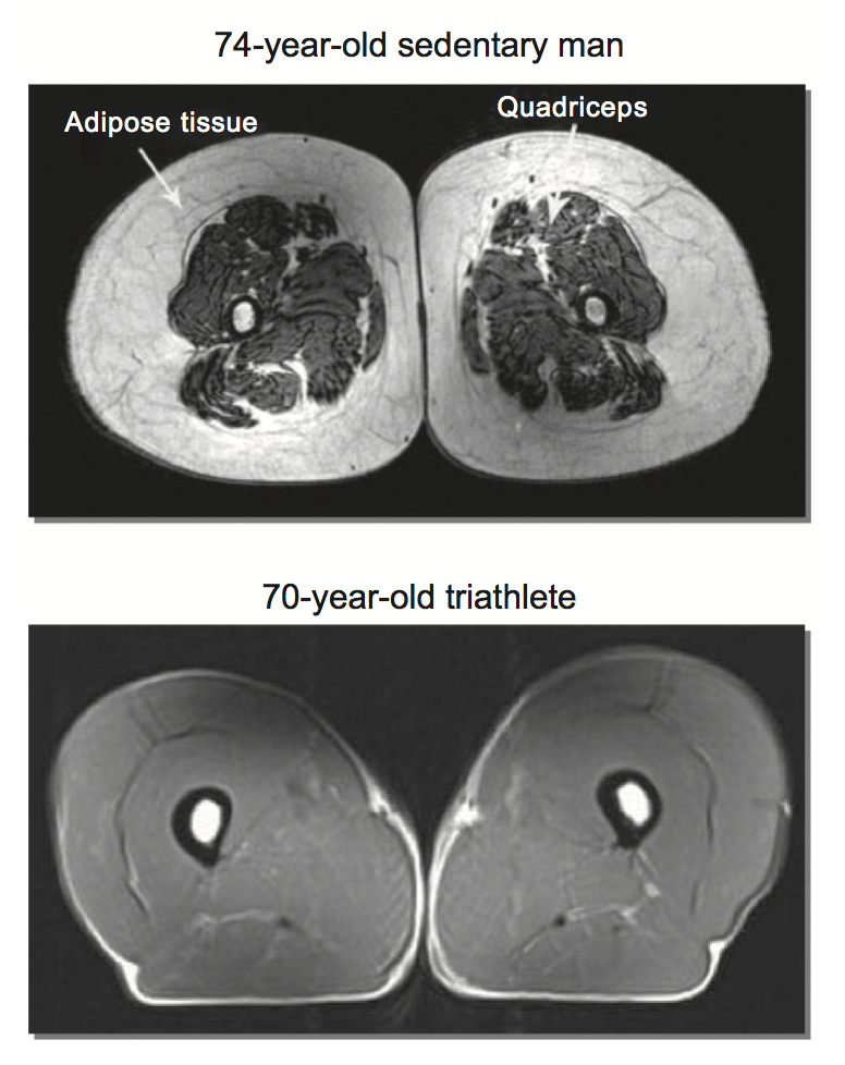 “Corte transversal del muslo de dos seniors, uno sedentario y otro triatleta, mostrando diferencia de masa muscular y efecto del ejercicio para mayores en el hueso”